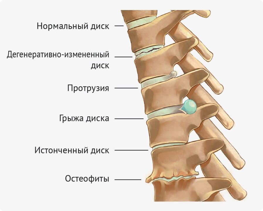 Disk Deformations for Lomber Osteocondrosis