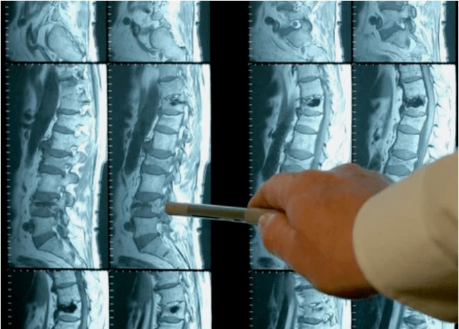 Types of osteocondrosis in the spine