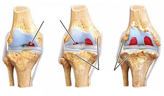 degree arthrosis