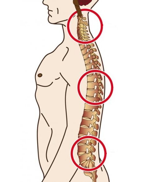 Spinal departments taken by osteocondrosis