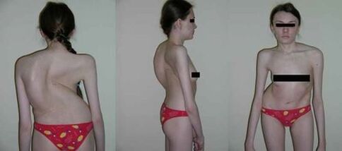 the curvature of the spine as a result of osteocondrosis