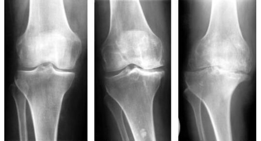 A mandatory diagnostic measure when determining knee arthrosis is an X-ray