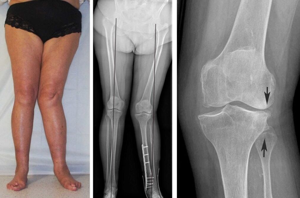 Advanced arthrosis of the knee joints is visually clear even without X-rays