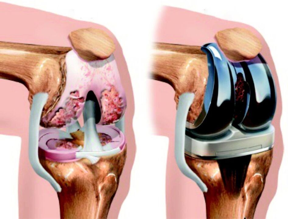 If the knee joint is completely damaged by arthrosis, it can be restored with endoprosthetics. 